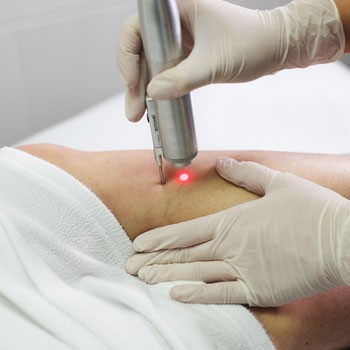 Laser treatment for varicose veins
