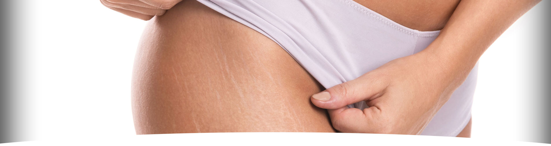 Reduction of stretch marks