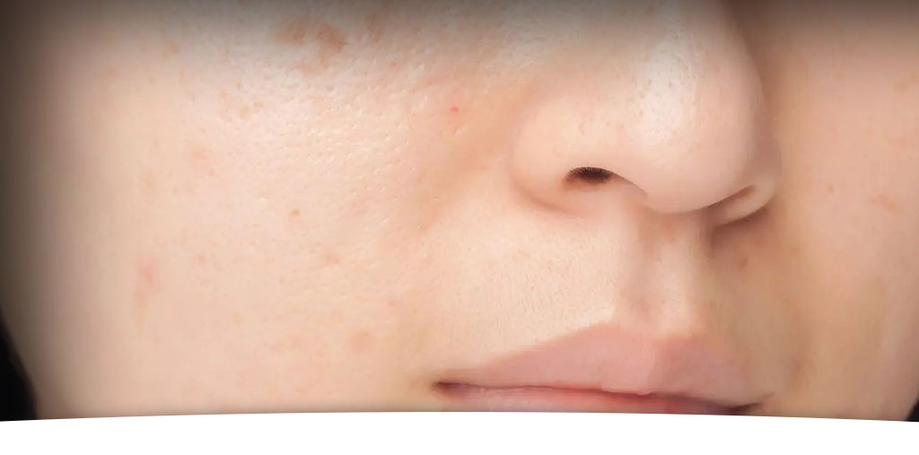 Treatment of acne and its scars