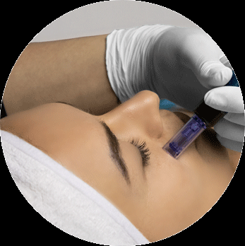 Microneedling PROMO 25%