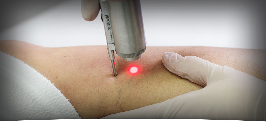 Laser treatment for varicose veins
